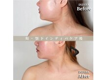 術後の女神 大阪本町店/ダウンタイムケア・インディバ