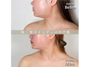 術後の女神 大阪本町店/ダウンタイムケア・インディバ