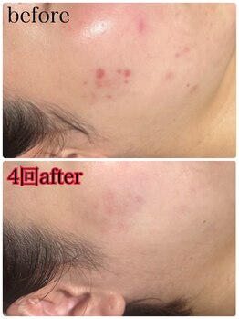 エミルカ 北谷店(EMILUCA)/ニキビ