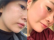 リメイクビューティークリニック(REMAKE BEAUTY CLINIC)/【症例】カカオジェントルピール