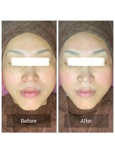 マリー(Mary.)/ハーブピーリング♪