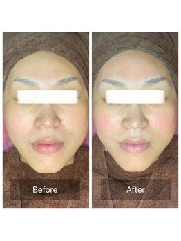 マリー(Mary.)/ハーブピーリング♪