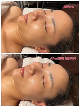 スーパースカルプ 大津店(SuperScalp)/お客様before/after写真