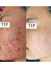 プランス 恵比寿店(PLANCE)/恵比寿/エステ/肌質改善