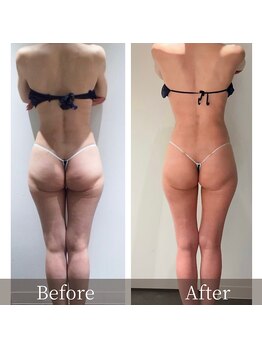 インフィニーズ(INFINEEZ)/カスタマイズ90分下半身痩せ