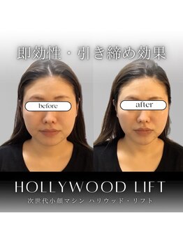 ブリリオプラス ナラ(Brillio plus NARA)/"ハリウッドリフト"の即効性★