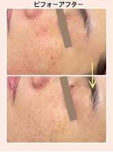 リファイン(REFINE)/シミケア！ハーブピーリング