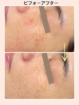 リファイン(REFINE)/シミケア！ハーブピーリング