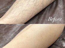 ボス 桑名店(BOSS)/足脱毛(before&after)