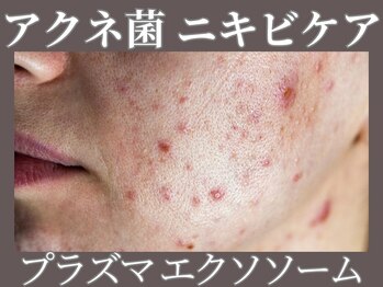 マヴィ 守口店(MavY.)/ニキビケアしませんか？