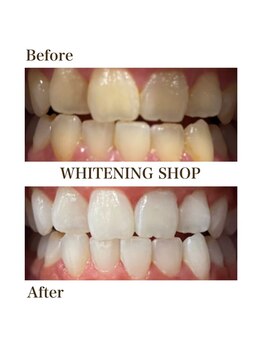 ホワイトニングショップ 高岡店/beforeafter