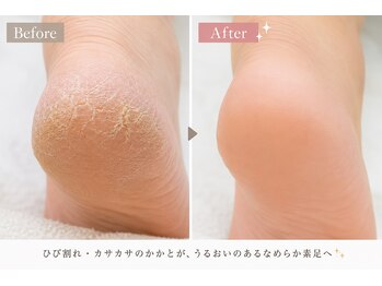 ロッティ(Lottie)の写真/諦めていたひび割れ・カサカサかかとへ！角質ケアと本格フットケアでなめらか美脚に☆