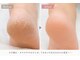 ロッティ(Lottie)の写真/諦めていたひび割れ・カサカサかかとへ！角質ケアと本格フットケアでなめらか美脚に☆