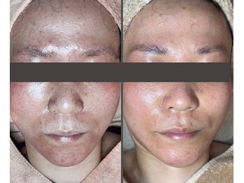 ベル(Bell)/肌質改善