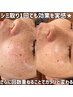 【本気のシミ対策】再来限定★シミケア30分放題プラン☆8000円