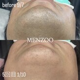 メンズー(MENZOO)