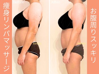 ミモザ鍼サロン(mimoza鍼サロン)/ラジオ波リンパケアの効果！！