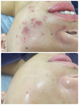 アリュール 京都烏丸御池店(ALLURE)/ハーブピーリング　#ニキビケア