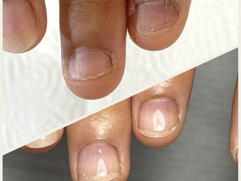 アルクネイル 成田(alku nail)の写真/【自爪育成初回¥14300★深爪矯正¥15400】噛み癖や深爪でお悩みの方も健康な自爪へ[成田/成田駅/パラジェル]