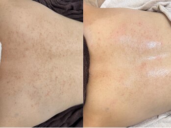 ニコレ(Nicore)/お背中・ニキビ・跡お悩み