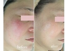 トリートメントルーム フェリーチェ(Felice)/赤みやゆらぎにハーブケア