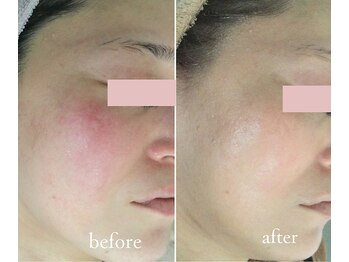 トリートメントルーム フェリーチェ(Felice)/赤みやゆらぎにハーブケア