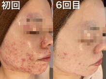 エヌエースキン 北谷店(NAskin)/ハーブピーリング｜ニキビケア