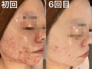 エヌエースキン 北谷店(NAskin)/ハーブピーリング｜ニキビケア