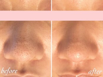 ピリナ 名古屋/【WAX毛穴ケア症例】名古屋/栄