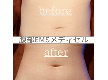 【腹部★筋膜リリースEMS】施術1回でこの効果！スッキリくびれ♪