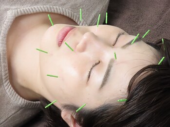 坂田鍼灸治療院の写真/【板橋駅3分】大人気美容鍼で気になるほうれい線・たるみに徹底アプローチ☆圧倒的効果で満足度◎