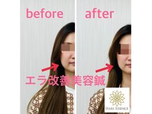ハリエッセンス(HARI ESSENCE)の雰囲気（あなたに合わせた刺鍼で変化もしっかり把握します【エラ張り】）