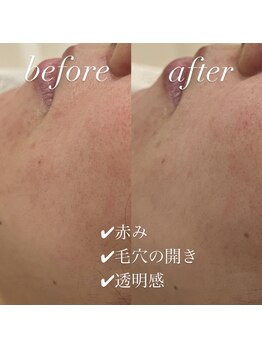 ヴィディトゥ(vidyto)/ENVIRON【毛穴開き/赤み】