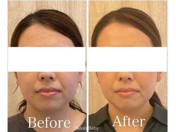 サロンベイビー 西宮本店(Salon Baby)/【BeforeAfter】小顔美容整顔
