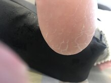 足のケア アンド 巻き爪 エムズ 白金通り店(M's)/乾燥系１