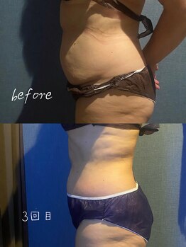 優来 神田店/肩甲骨施術の例