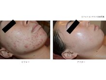 ベルメイク(BELLE MAKE)/水光ピール☆ビフォーアフター