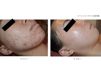 ベルメイク(BELLE MAKE)/水光ピール☆ビフォーアフター