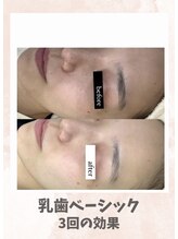 リンフェイス 浦安店(RINFACE)/赤み、毛穴の肌改善されたい方