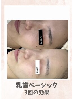 リンフェイス 浦安店(RINFACE)/赤み、毛穴の肌改善されたい方