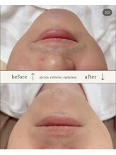 カッツ 宮通り(CUTS)/CUT'Sハイブリット脱毛