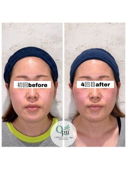 キュープ 相模原淵野辺店(Qpu)/たった4回で人生で1番小さな顔に