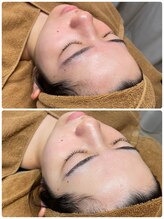 ラクシー 船橋(luxssy)/お顔シェービング×クレイパック