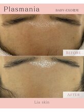 リアスキン(Lia skin)/プラズマニアのビフォーアフター