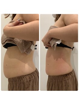 フォースカッター痩身/YUKA施術