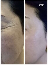 プランス 渋谷(PLANCE)/毛穴/ハーブ/ニキビケア