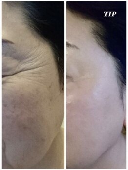 プランス 渋谷(PLANCE)/毛穴/ハーブ/ニキビケア