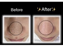 エムドット(M.)/ハイドロフェイシャル