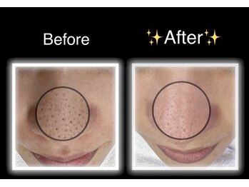 エムドット(M.)/ハイドロフェイシャル