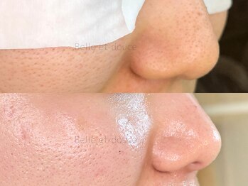 ベルエドゥース(Belle et Douce)/毛穴角栓、開き症例